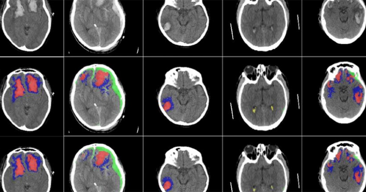 Chụp CT sọ não giúp đánh giá được cấu trúc xương và nhu mô não  
