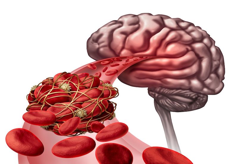 Rất nhiều người có chung lo lắng: tắc mạch máu não có nguy hiểm không?