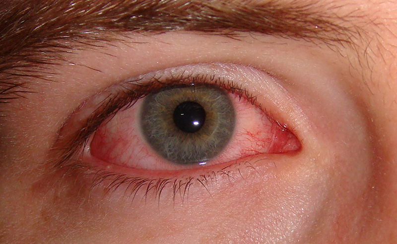 Tình trạng mắt đỏ có thể xảy ra với bất cứ ai