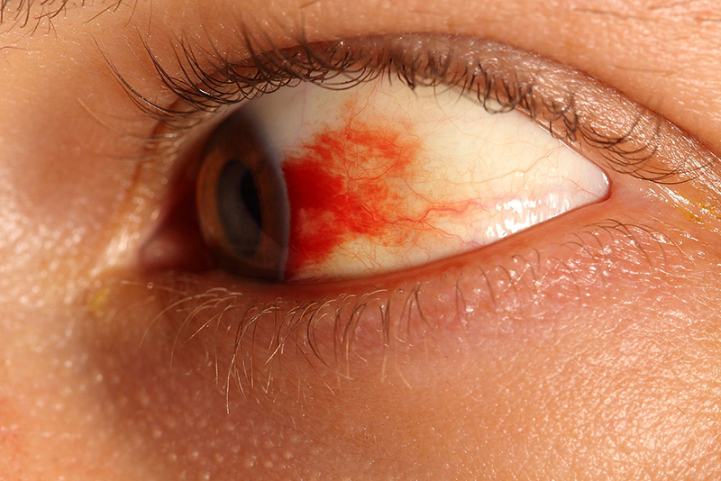 Xuất huyết dưới mắt gây mắt đỏ là do sự vỡ ra của các mạch máu nhỏ dưới niêm mạc