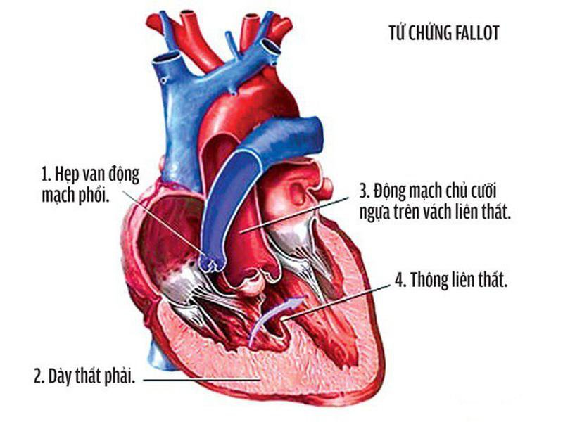 Bất thường về tim là một trong những dị tật ở trẻ sơ sinh hay gặp