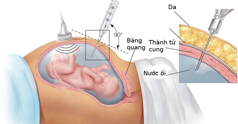 Sàng lọc trước sinh giúp phát hiện sớm dị tật bẩm sinh ngay từ trong bào thai