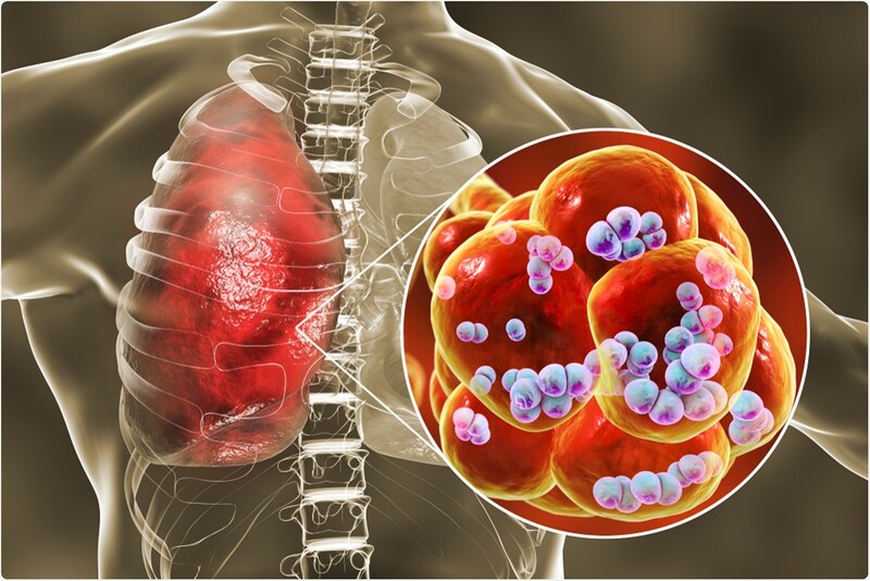  Vi khuẩn Streptococcus pneumoniae là nguyên nhân hàng đầu gây viêm phổi