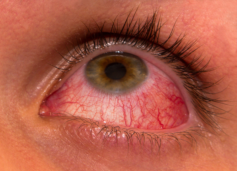 Củng mạc mắt đỏ là triệu chứng dễ nhận biết khi viêm kết mạc cấp tính