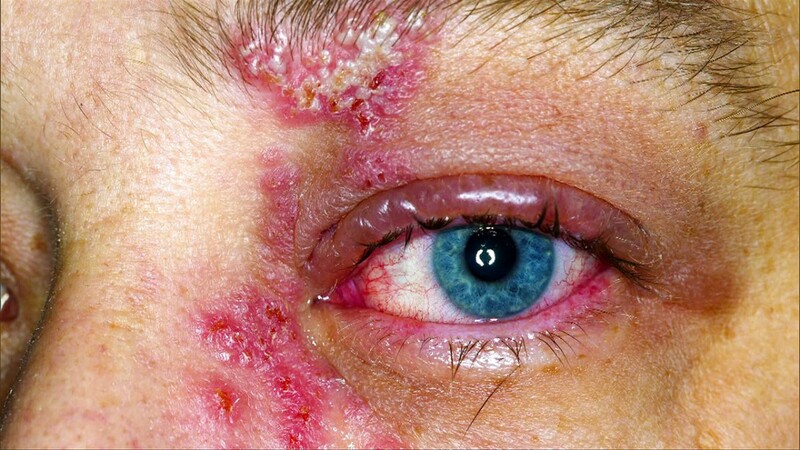 Khi virus VZV tấn công vào các dây thần kinh mắt thì sẽ gây tổn thương mắt, giác mạc và vùng da xung quanh mắt