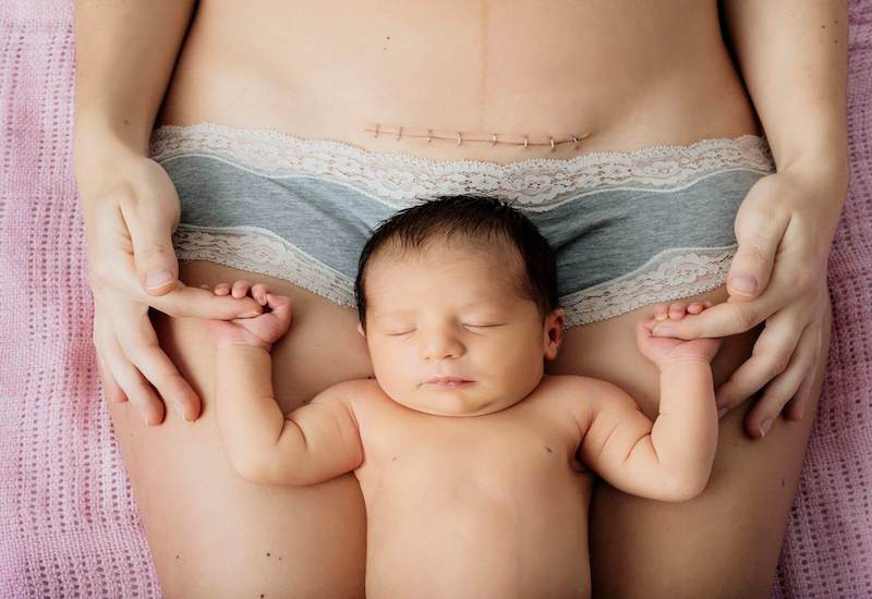 Càng  sinh mổ nhiều lần mẹ bầu càng đối diện với nhiều nguy cơ