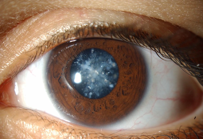 Đục thủy tinh thể là biến chứng nguy hiểm của tật khuyết mống mắt