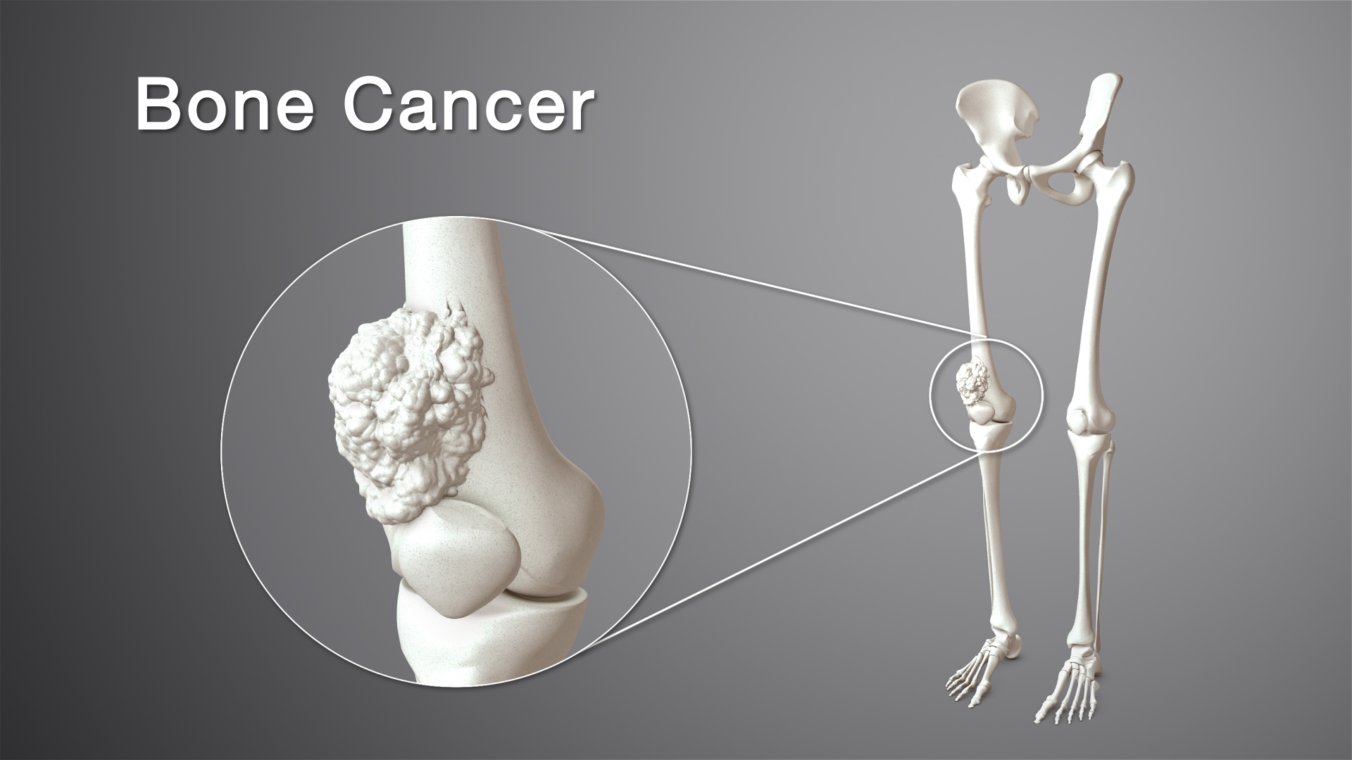 Ung thư xương phần lớn là ung thư thứ phát do di căn từ một ung thư khác đến hoặc có rất nhiều nguyên nhân khác.