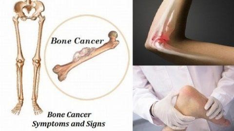 Ung thư xương gây đau nhức xương khớp