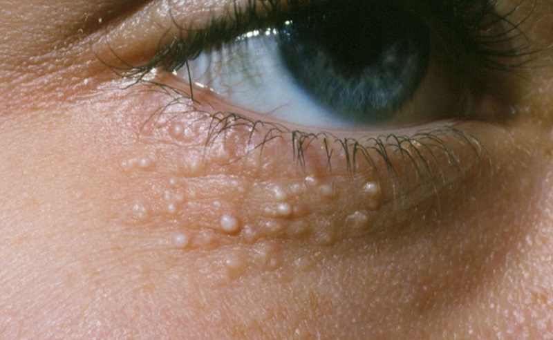 Mụn thịt ở mắt hình thành chủ yếu do keratin tích tụ quá nhiều bên dưới da