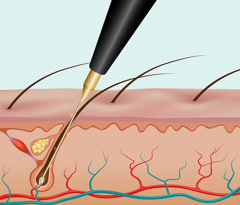 triệt lông vĩnh viễn là phương pháp sử dụng dòng điện để đốt và phá hủy quá trình phát triển của nang lông