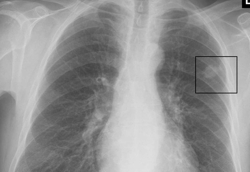 Chụp X-quang phổi để chẩn đoán bệnh lao