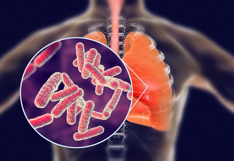 Vi khuẩn Mycobacterium tuberculosis gây bệnh lao