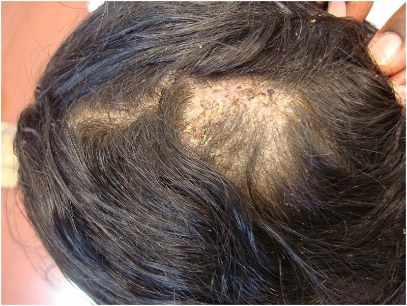 Tổn thương trên da do nấm da đầu gây ra