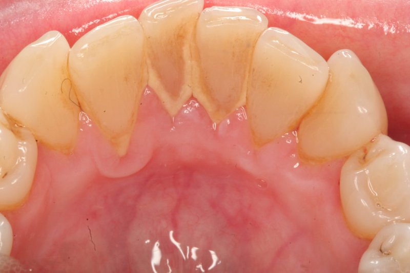 Mảng bám tích tụ lâu ngày hình thành cao răng là môi trường hoạt động của vi khuẩn