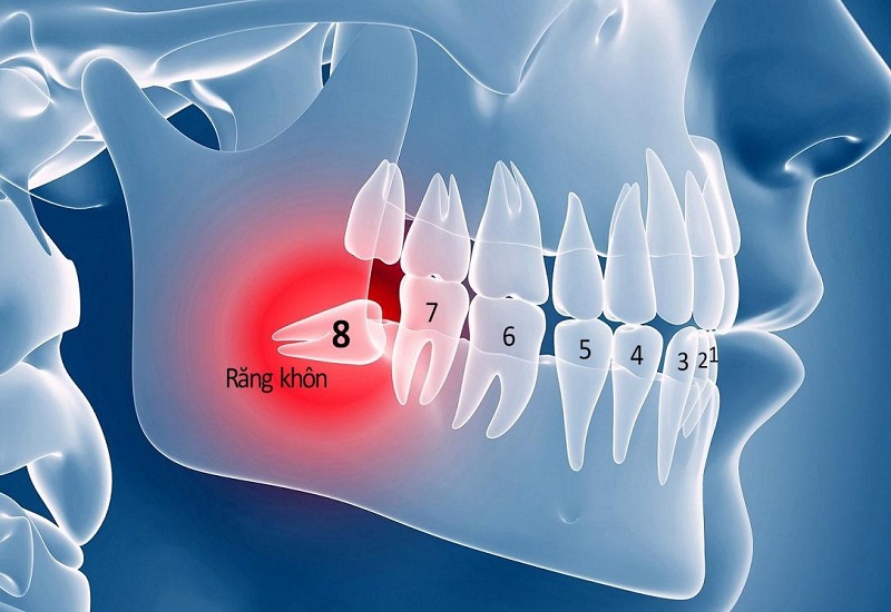 Răng khôn mọc lệch cần nhổ tại cơ sở y khoa uy tín để tránh biến chứng nguy hiểm