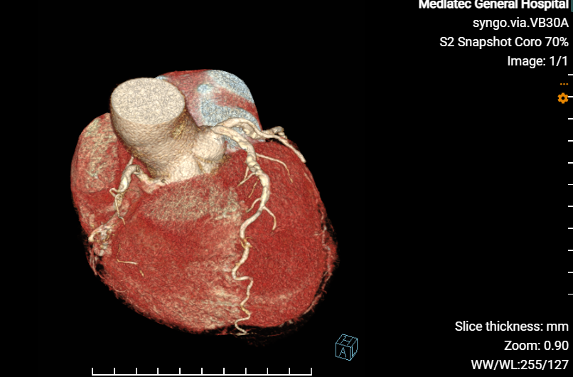 Hình ảnh chụp MSCT mạch vành  tại bệnh viện MEDLATEC 