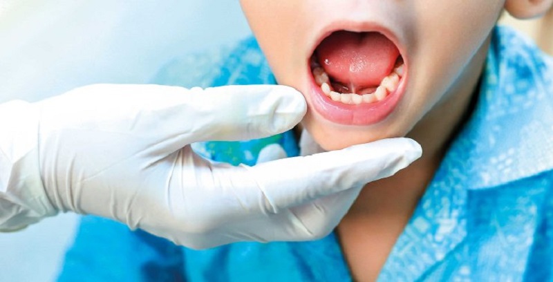 Dính thắng lưỡi là một dạng dị tật bẩm sinh có thể xảy ra ở trẻ khi chào đời