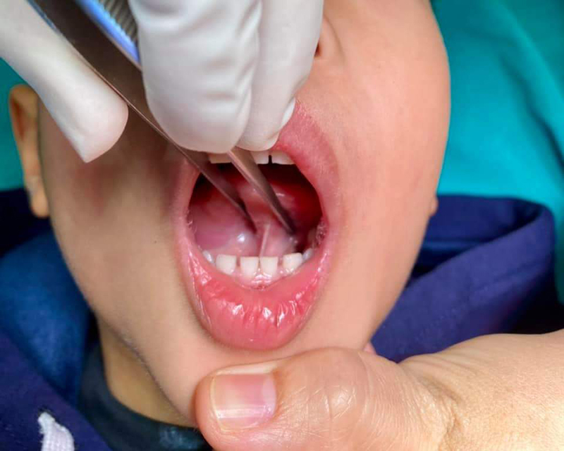 Phẫu thuật cắt thắng lưỡi là phương pháp điều trị hiệu quả nhất tật dính thắng lưỡi ở trẻ