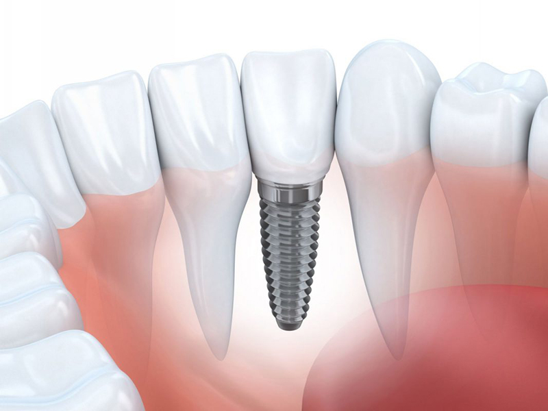Cấy ghép implant là phương pháp nha khoa giúp thay thế răng thật tối ưu nhất hiện nay