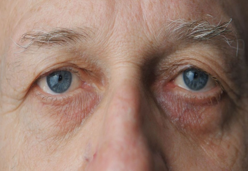 Người cao tuổi có nguy cơ cao bị vẩn đục dịch kính
