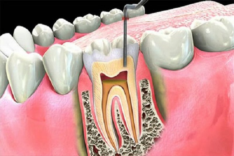 Lấy tủy răng giúp cho phần viêm nhiễm bị loại bỏ, ngăn ngừa lây lan sâu răng đến các răng lân cận
