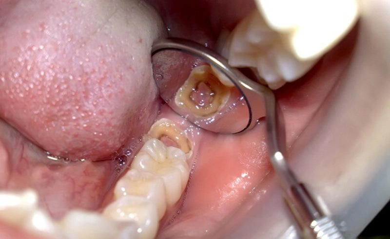 Răng sâu cần phải được lấy tủy để không lây lan đến các răng khác
