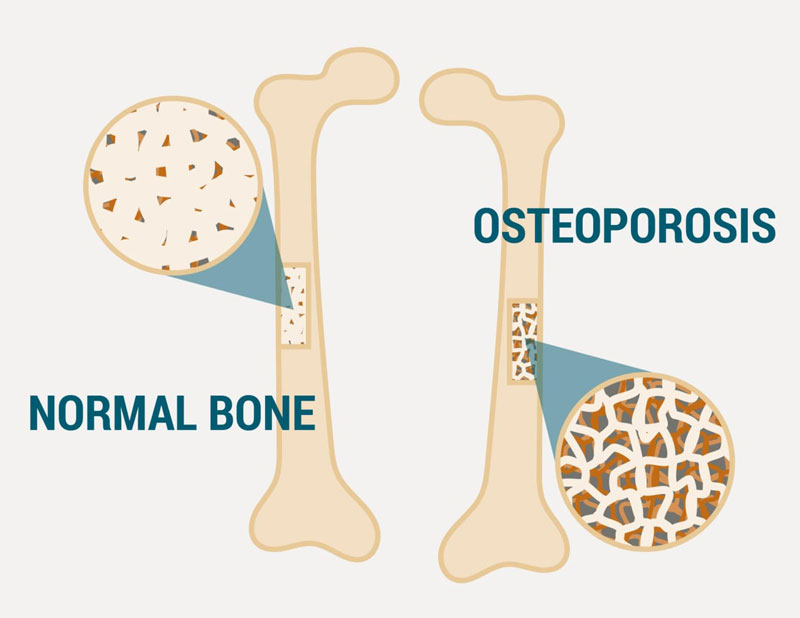 Đau xương cột sống do tình trạng loãng xương