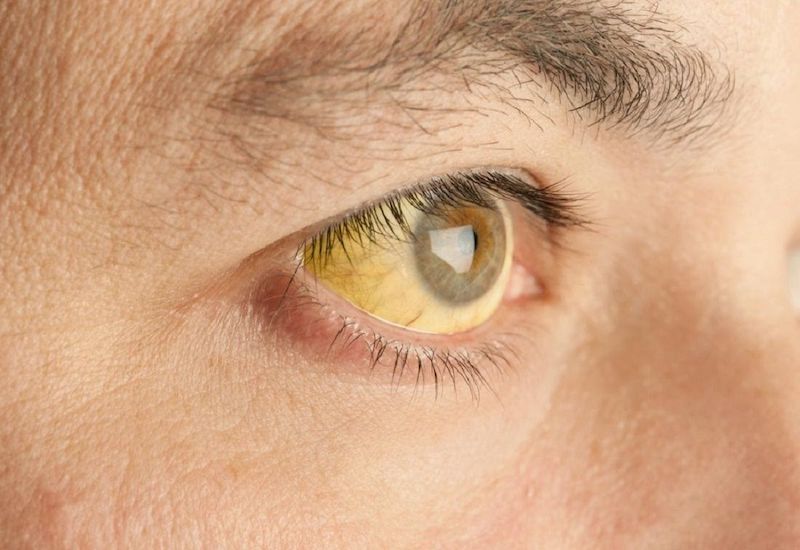 Bệnh nhân bị viêm gan B mạn tính thường có triệu chứng vàng mắt vàng da