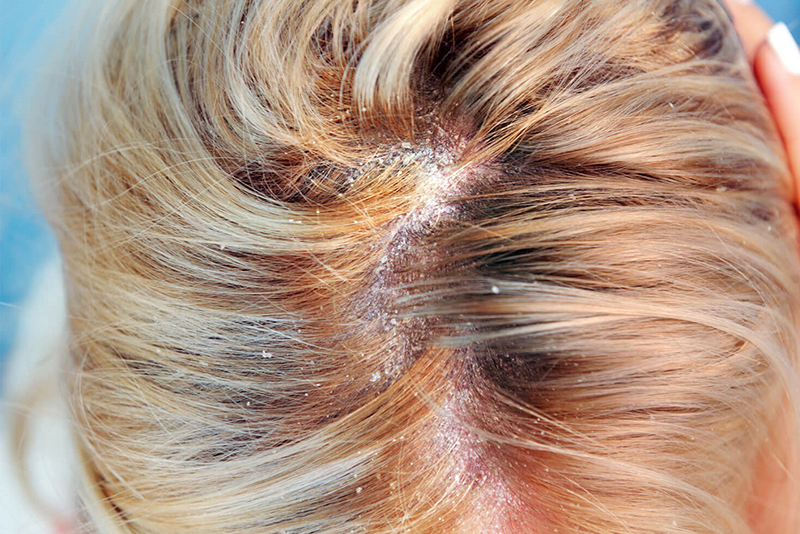 Bệnh nấm da đầu khiến cho người bệnh thiếu tự tin khi giao tiếp