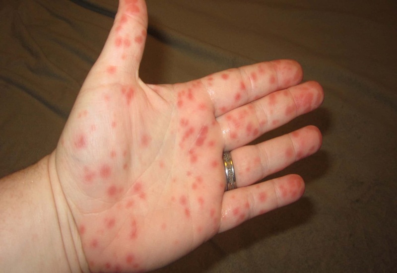 Hạ tiểu cầu là biến chứng nguy hiểm của bệnh sốt xuất huyết