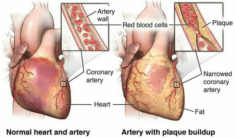Bệnh thiếu máu cục bộ có thể ảnh hưởng tới hoạt động của hệ tim mạch