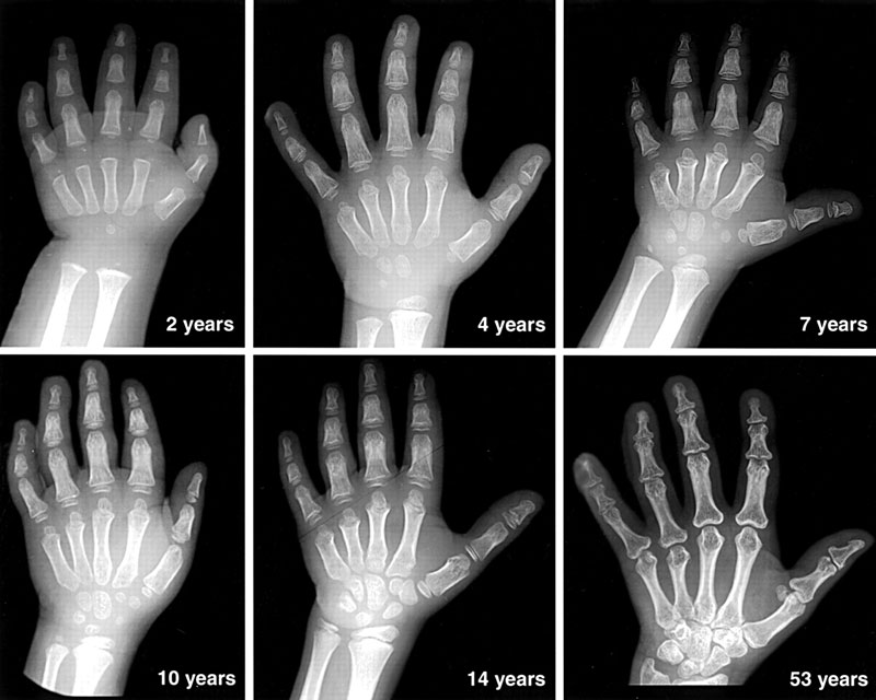 Để xác định tuổi xương, các bác sĩ sẽ sử dụng kỹ thuật chẩn đoán hình ảnh X-quang