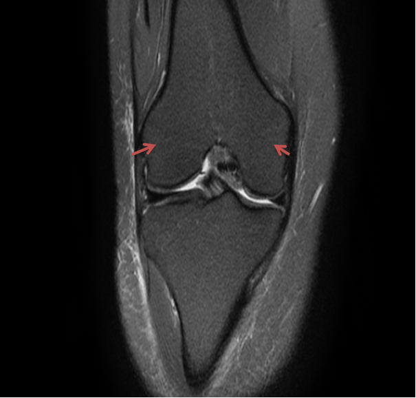 Hình ảnh MRI sụn chêm trong và sụn chêm ngoài mặt phẳng coronal khớp gối.
