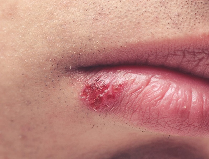 Herpes sinh dục có thể bị ở miệng và nhiều vùng khác nhau trên cơ thể
