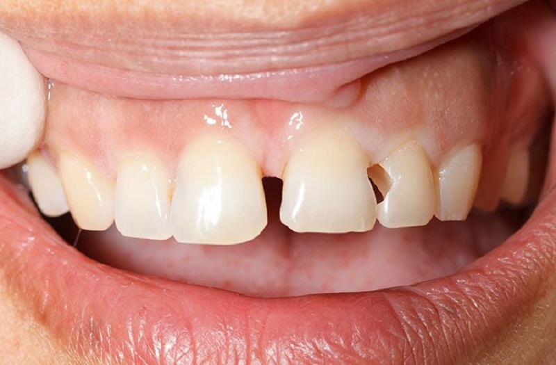 Răng bị mẻ do cắn phải vật cứng