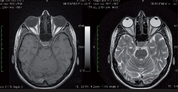 Phương pháp MRI hốc mắt và thần kinh thị giác cũng có những ưu nhược điểm riêng