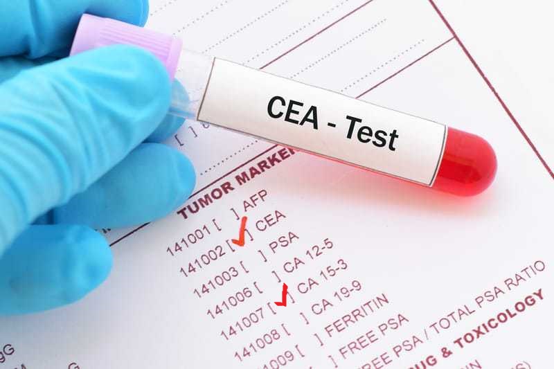 Xét nghiệm CEA phát hiện ung thư là một trong những “xét nghiệm vàng” hiện nay
