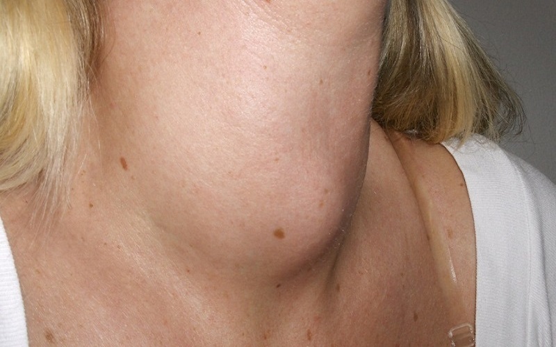 Bướu cổ là một trong số những biểu hiện thường thấy của các bệnh lý tuyến giáp