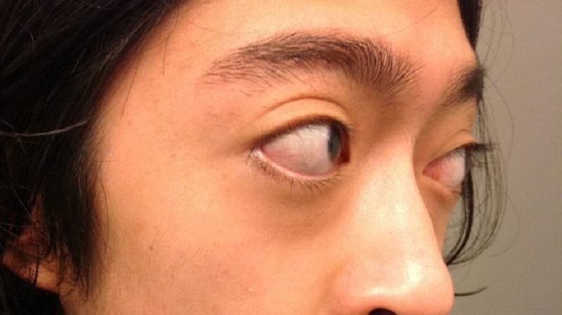Mắt lồi khi bị bệnh lý tuyến giáp