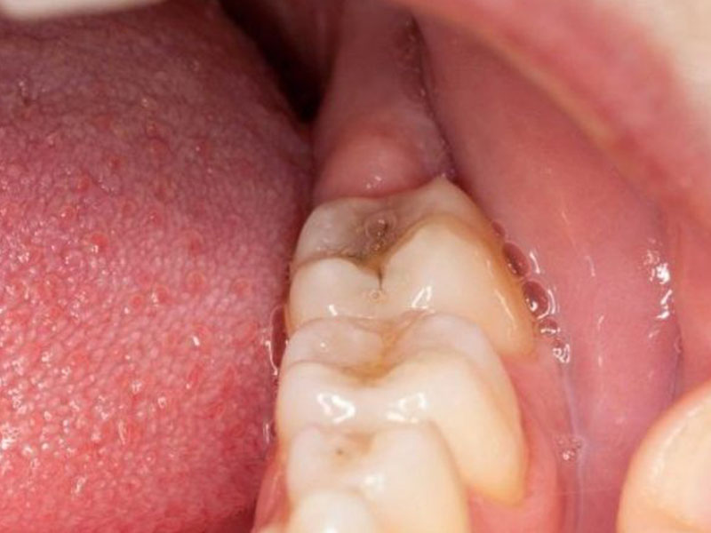 Mọc răng khôn có thể biến chứng áp xe răng
