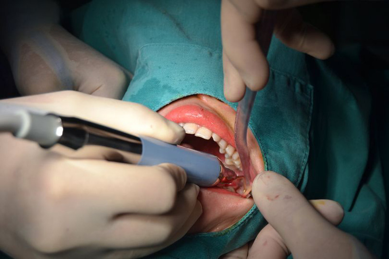 Nhổ răng khôn cần được thực hiện ở cơ sở nha khoa uy tín để đảm bảo an toàn