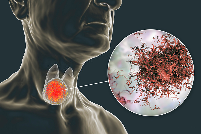 Sinh tuyến cho tuyến giáp được thực hiện với người bệnh có các khối u bất thường nghi ngờ ung thư