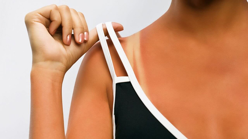 Tiếp xúc nhiều với ánh nắng mặt trời sẽ làm tăng nồng độ Melanin tích tụ trên da