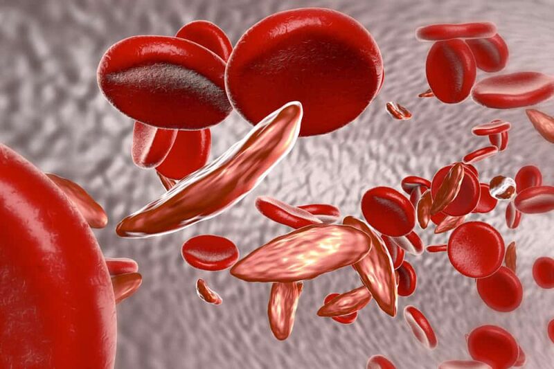 Chỉ số RDW có nhiều giá trị trong chẩn đoán bệnh về máu