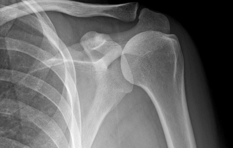 Chụp X-quang để chẩn đoán được viêm tuỷ xương