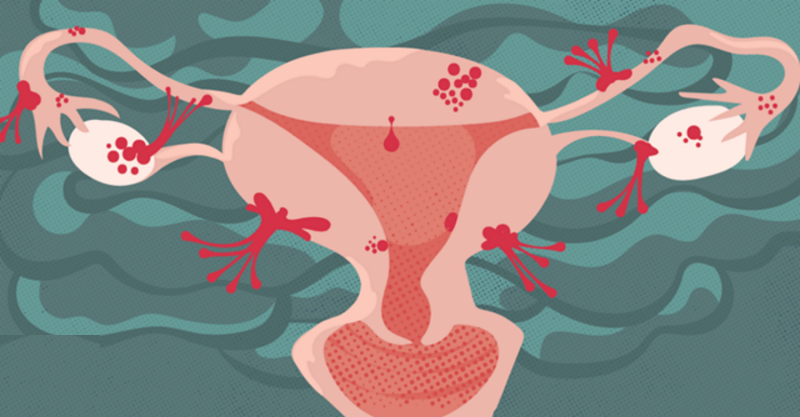 Lạc nội mạc tử cung căn bệnh khá phổ biến ở nữ giới