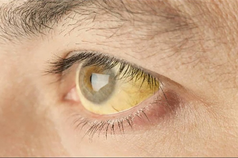 Virus viêm gan E thường khiến cho tròng mắt người bệnh có màu vàng