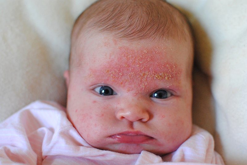 Bong tróc da là tình trạng khá phổ biến ở trẻ sơ sinh