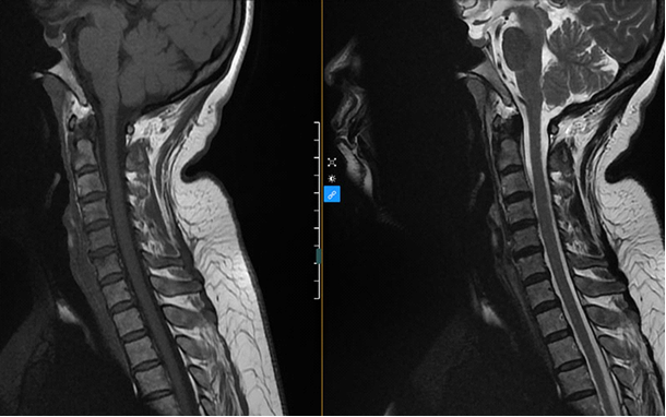 Chụp cộng hưởng từ cột sống cổ chuỗi xung T1, T2 sagittal 